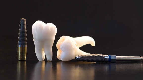 Implantologie soll preiswerter werden