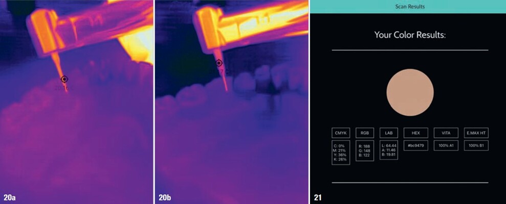 Figs. 20a & b: Dental Thermal App recording the surface temperature of the Stabilok Twist Drill at 20.16 °C (a) and the dentine pin at 21.17 °C (b). Fig. 21: SmileShade assessment of the pinlay, showing a 100% match to Shade A1.