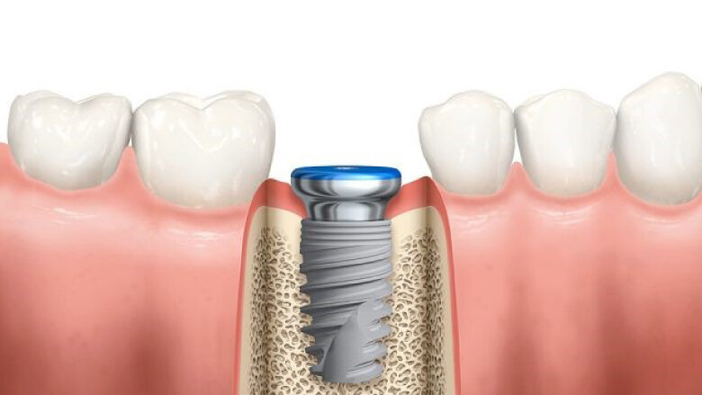 Oseointegrace implantátu