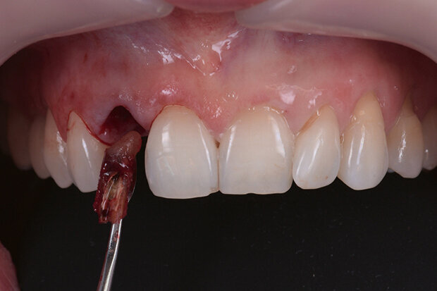 Fig. 9. Atraumatic tooth extraction
