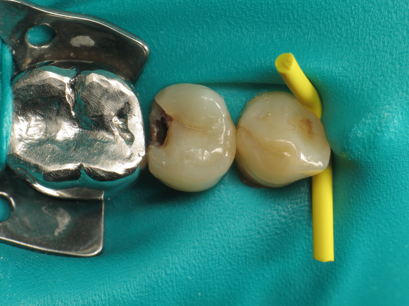 Fig. 2: Application of the dental dam.