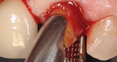 Impianto in zirconia post-estrattivo immediate