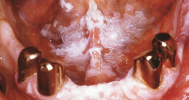 Die Rolle des Geschlechts bei prämalignen Erkrankungen der Mundschleimhaut