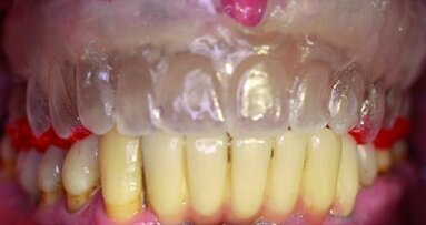 Empreinte et enregistrement pour prothèses complètes amovibles supra-implantaires