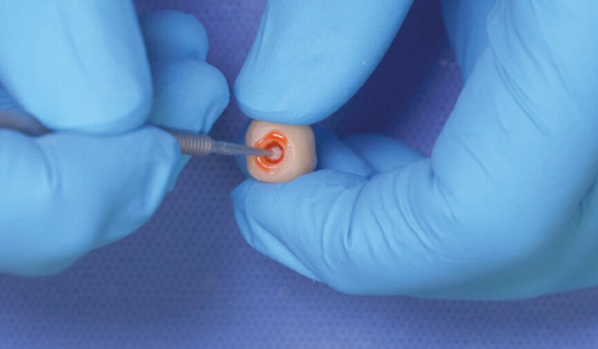 Fig. 7: If seating a lithium disilicate crown, etch the internal surfaces with a 5% hydrofluoric acid for 20 seconds and then rinse and dry the surfaces. If seating a zirconia crown, air abrade the internal surfaces at 96.5–399.9 kPa. 