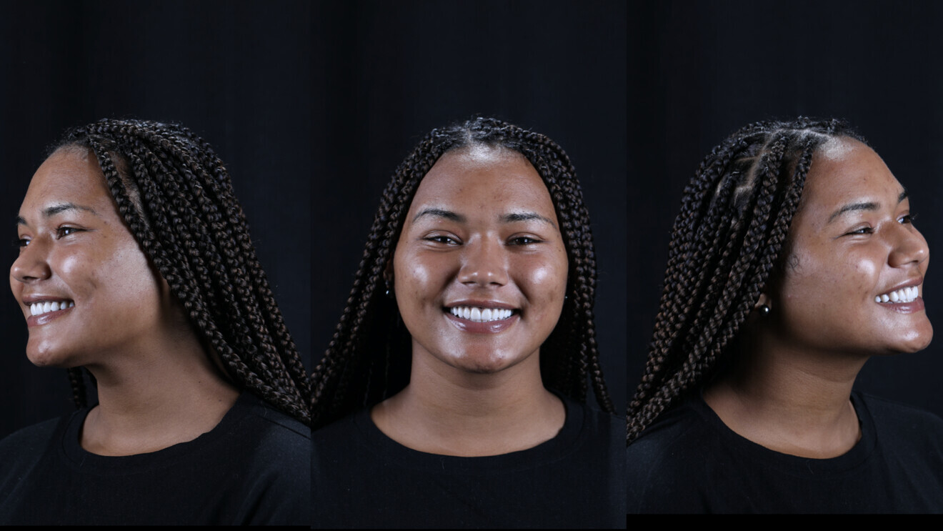 Fig. 11: Post-op full-face views.