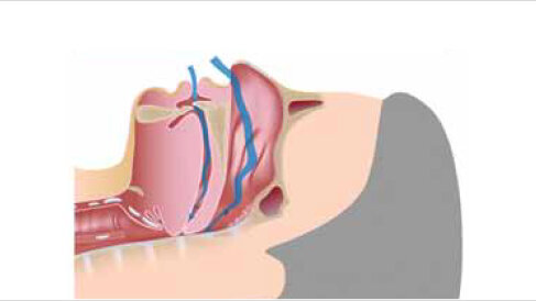 Spánková apnoe a ortodoncie: interdisciplinární přístup k léčbě chronické spánkové poruchy