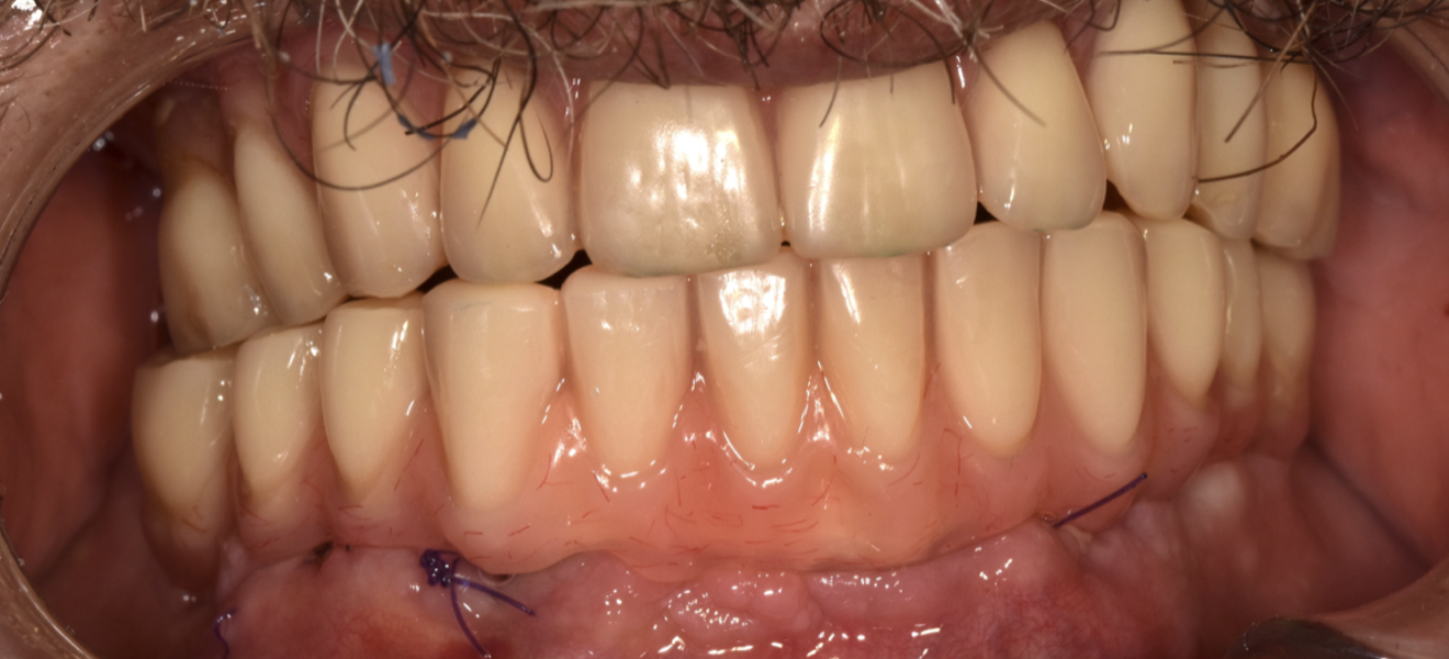 Fig. 7 : Prothèse Zantex PMMA vissée en place.