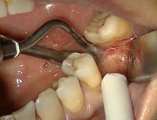 Fig. 14 - Con sicurezza, rapidità e precisione è attualmente possibile preparare un sito implantare senza ricorrere all’utilizzo di strumenti rotanti, con una tecnica esclusivamente sonica. 