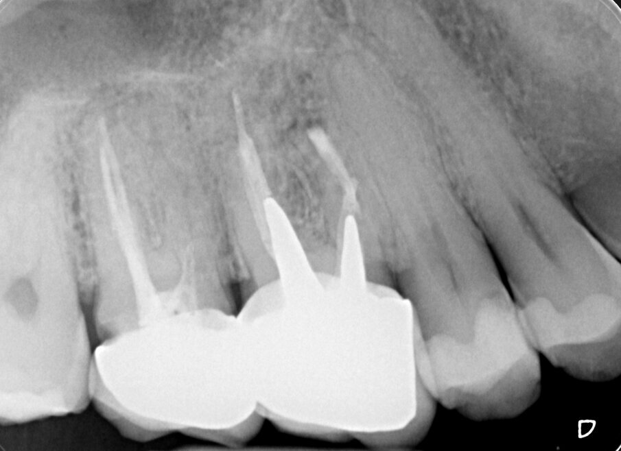 Fig. 1j - Radiografia di controllo dopo due anni.