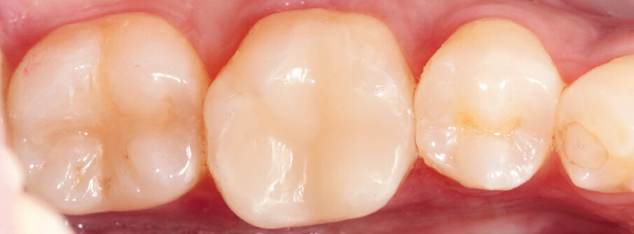 Fig. 16: Inlay in situ: great optical integration thanks to chameleon effect