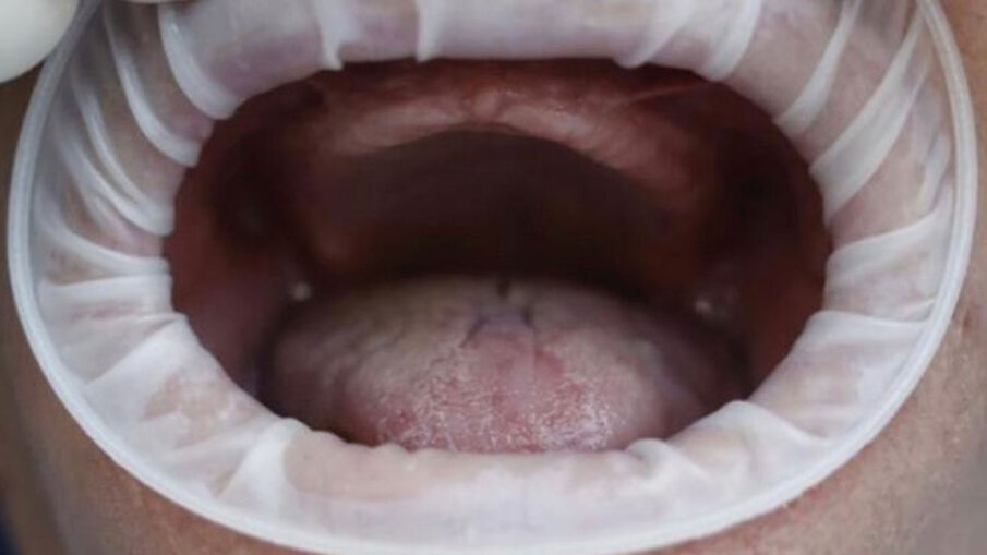 Fig. 4 - Foto della mucosa prima dell’inserimento del device.
