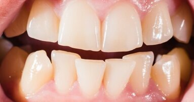 Ранният стрес може да доведе до асиметрична оклузия