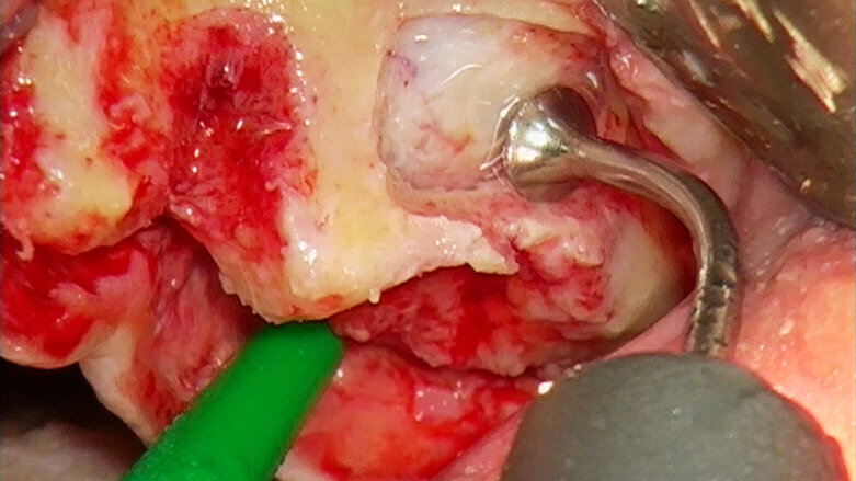 Piezochirurgie je metodou volby