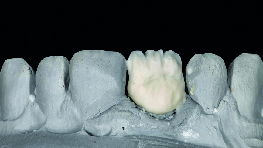 Fig. 7 : Application de la formule correspondant à la dentine cervicale. 