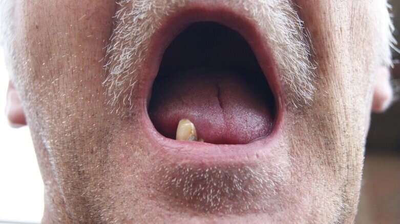 “Zonder voortanden is het lastig solliciteren”