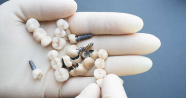 Pesquisadores alemães desenvolvem material de alta resistência para coroa dentária