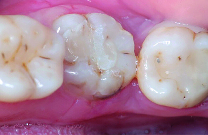 Fig. 14d: Clinical image: Control after one month.