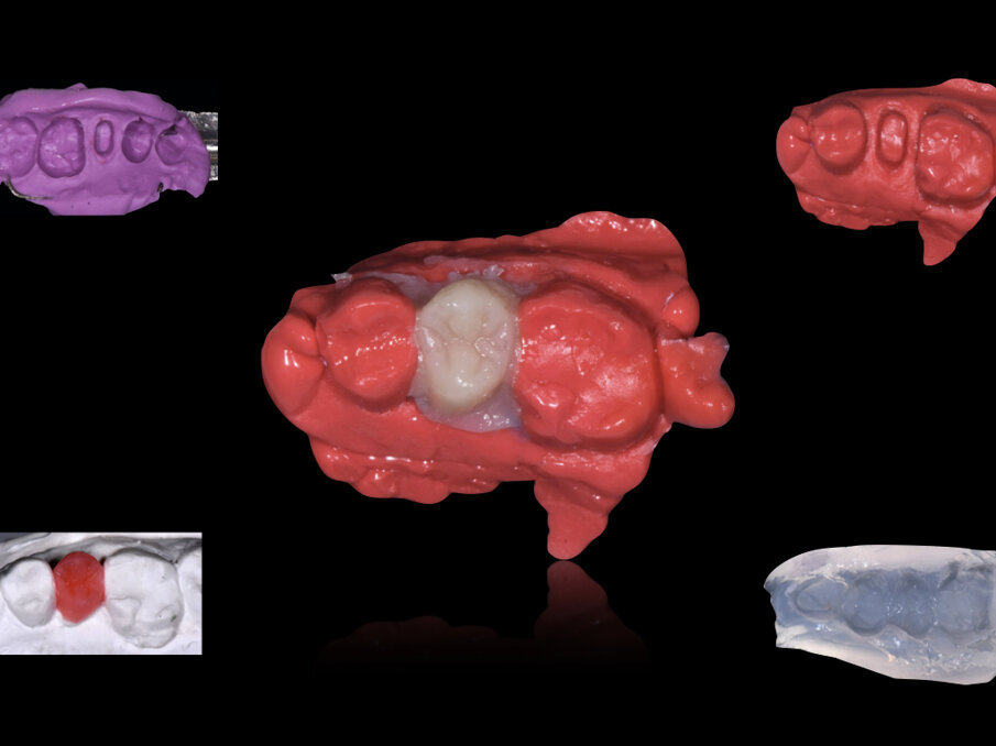 Fig. 3: Fabricación en el mismo consultorio de una prótesis provisional indirecta con un composite autopolimerizable (Structur 3, VOCO) utilizando GrandioSO Inlay System (VOCO).