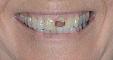 Immediate implant placement and restoration in fractured incisor with external root resorption