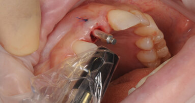 Interview: “ISQ is one of the key indicators for immediate loading when desired”