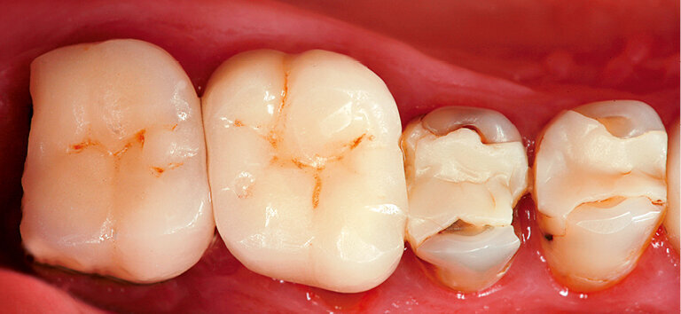 Fig. 4: Defective restorations in the upper posterior region in urgent need of repair