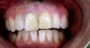 Der lange Weg zur Frontzahnästhetik