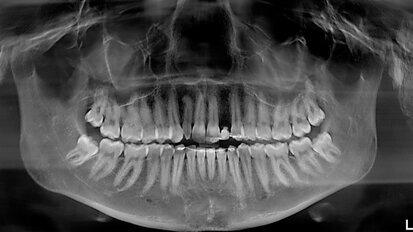 Gestione multidisciplinare di paziente con agenesia