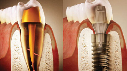 Zpět k počátku… Část II: Endodonticko-implantologický algoritmus založený na důkazech