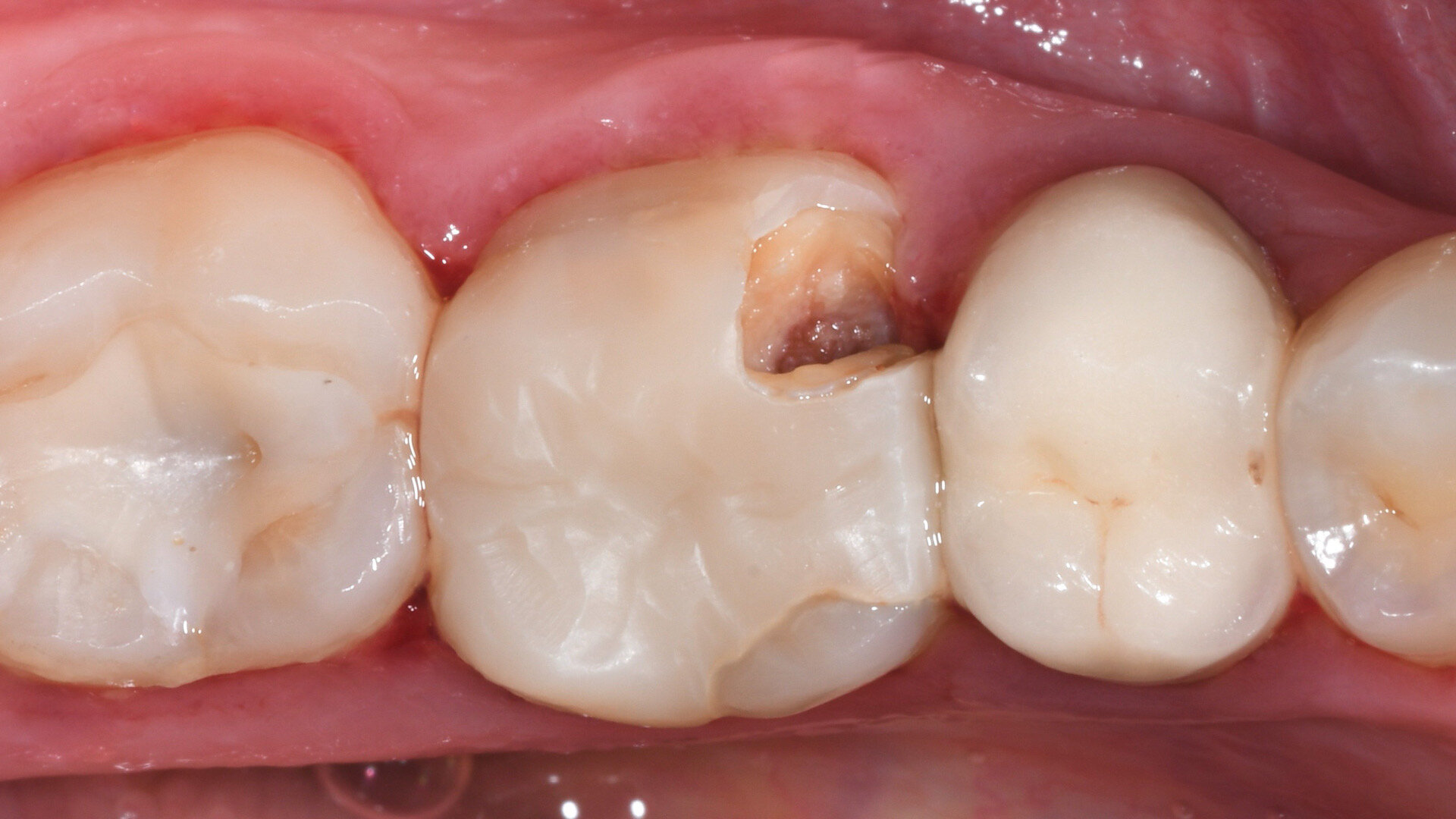 A single-visit digital workflow for endodontic treatment and restoration