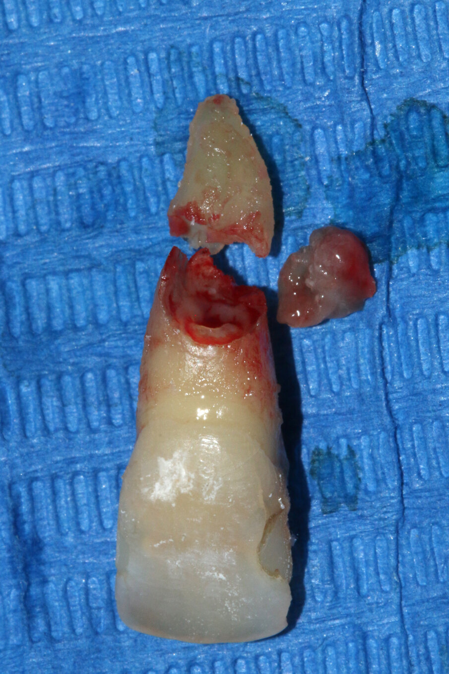 Fig. 2_L’elemento dentario in questione, appena estratto per intero.