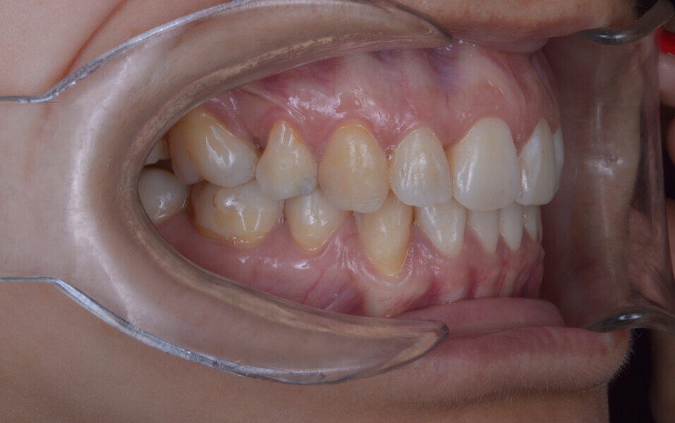 Fig. 7c: Final intra-oral photographs.