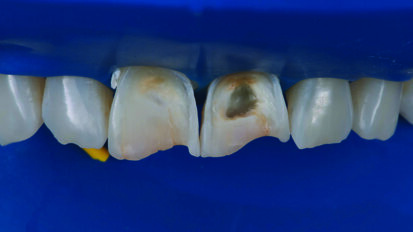 6 ways to avoid teeth from chipping