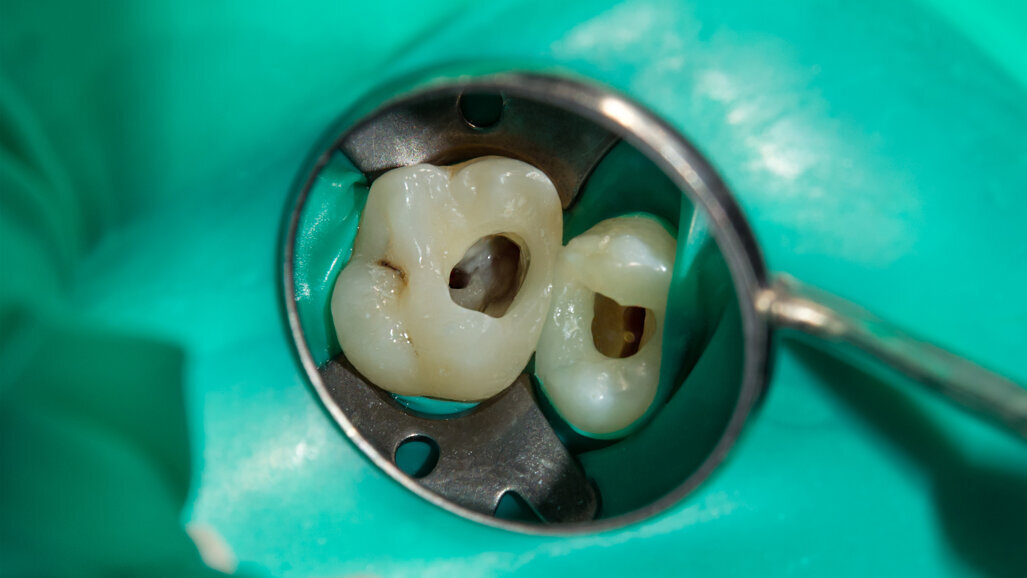 Hybrid shaping with MG3 rotary system