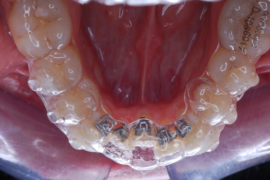 Fig. 33: Aligner with movement channels incorporated into the design to allow teeth to move even when the aligner was placed over them. Teeth used as anchorage had no spaces so that the aligner fitted snuggly over them.