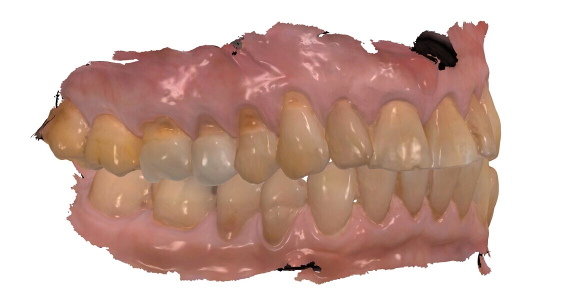 Fig. 2-4: Examples of full-arch intra-oral scans taken with an intra-oral scanner.