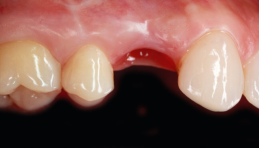 Fig. 36: Extraction and immediate implantation was followed by a temporization phase, at the end of which a pleasing emergence profile had developed.
