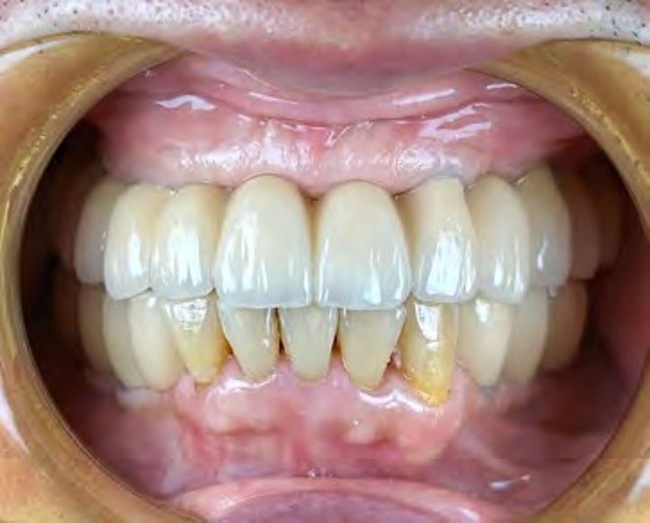 Fig. 3e: Frontal intraoral view after delivery of the definitive maxillary implant-supported prosthesis, showing restored occlusion and aesthetics.