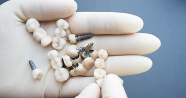 German researchers develop high-strength material for dental crown