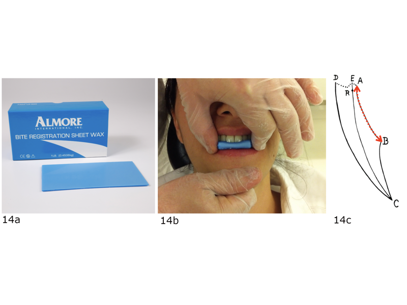 Figs. 14a–c: (a) Wax registration material. (b) Bite registration of the arc of closure for the placement of occlusal stops. (c) Envelope of motion A = occlusion in the arc of closure; B = maximum opening in rotation only; C = maximum total opening, a combination of rotation and translation of the condyles; D = maximum protrusion with tooth contacts; E = habitual occlusion (compensation of the jaw when teeth don´t match the arc of closure). R = resting position of the lower jaw.