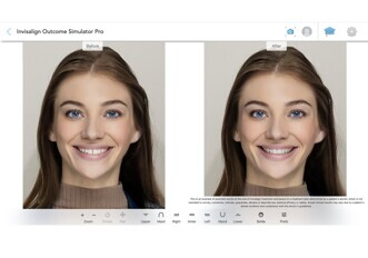 Align Technology – Invisalign Outcome Simulator Pro