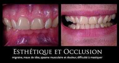Dentisterie adhésive totale : tout est dans l'équilibre occlusal