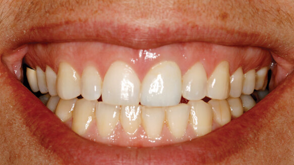 Restorative-driven implant dentistry: The future is now