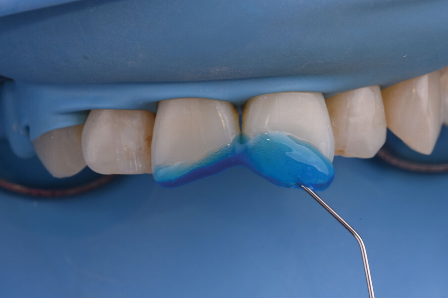 Sl. 7a: Nagrizanje ortofosfornom kiselinom, ispiranje  i aplikacija adheziva (7b). 