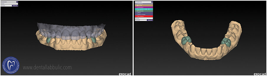 Slika 5: dizajniranje prototipa krunica u Exocad DentalCAD programu; stomatološka ordinacija Veljkov, dr Dejan Veljkov