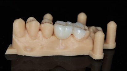 Casus: De posterior cantilever adhesiefbrug