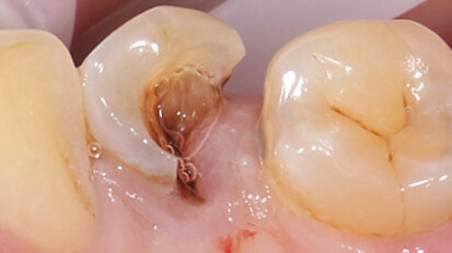 Restauración mediante endocorona de cerámica de feldespato Restauración mediante endocorona de cerámica de feldespato