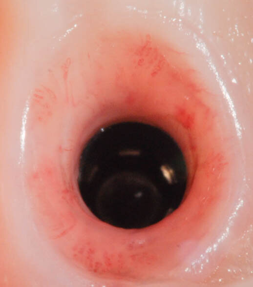 Fig. 17_Dettaglio tragitto transmucoso.