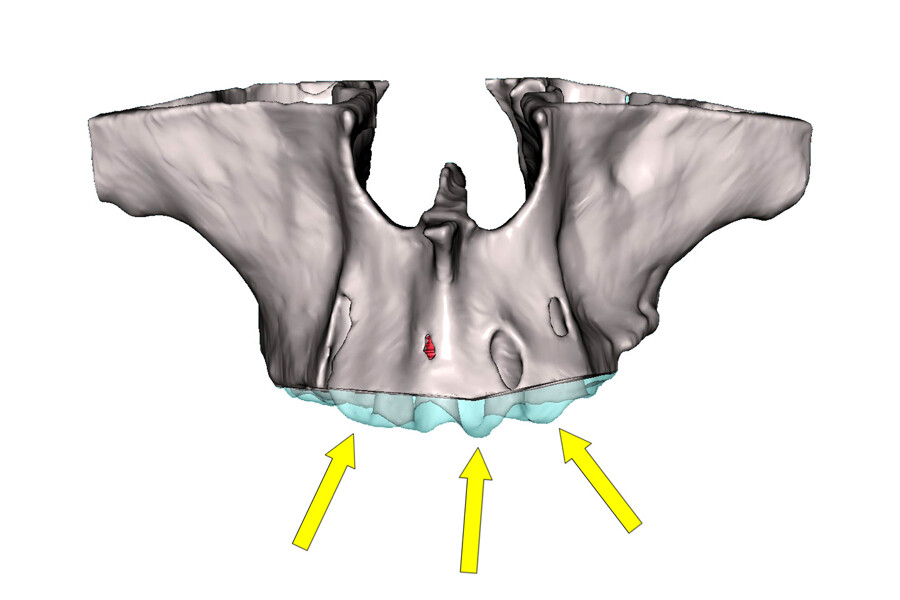 Figs. 8a–c: 3D segmentation of the maxilla illustrating the planned bone reduction (a) and implant positioning, indicated by yellow abutment projections (b & c).