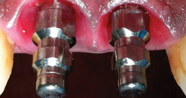 ULTRATOOTH: One visit, one hour, new tooth